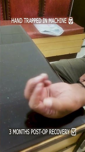 Severe Hand Crush Injury: K-Wire Fixation Recovery 🦴 #HandSurgery