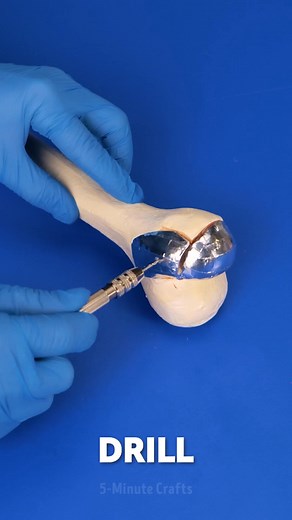 37K views · 28 reactions | See How Knee Replacement Done Safely | 5-Minute Recycle | Facebook