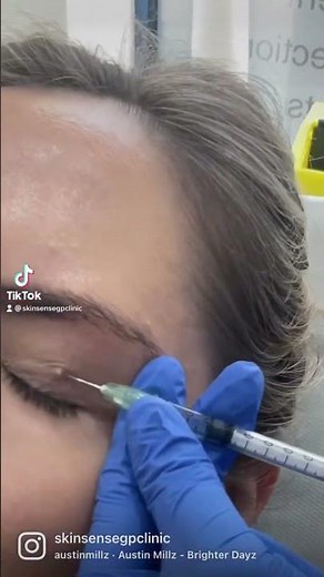 Skin Tag/ Skin lesion near the eye treatment by our Doctors 👏🏼