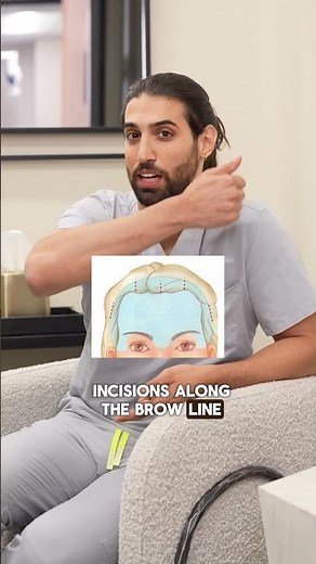 An endoscopic brow lift! #browlift #cosmeticsurgery #drsean