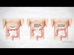 Resection of Colon Surgery or Colectomy ; Uses, Types, Approaches, Procedure