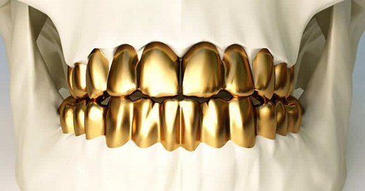 ✨ Permanent Gold Teeth Guide: Implants, Crowns, & Grillz - Dentaly.org