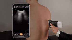 Lung Ultrasound Scan | Clarius