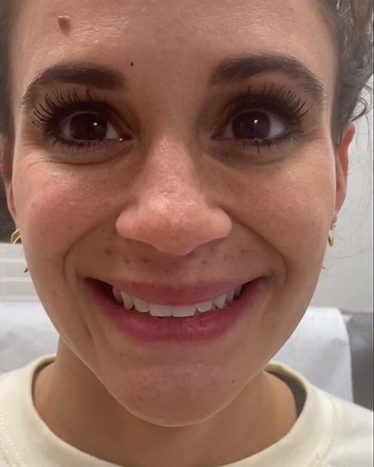 Filler Treatment on Upper Lip Smile Crease - Juvederm Volbella