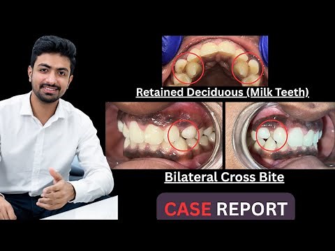 Extraction of Milk Tooth | Painless Baby Tooth Removal Explained