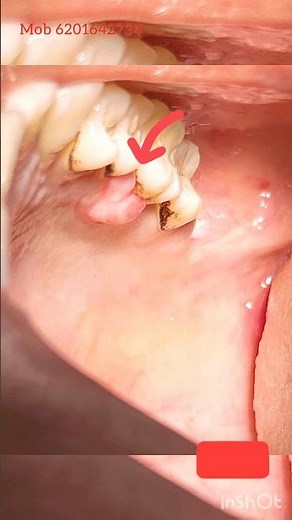 Excision of Pyogenic Granuloma || Epulis Removal Surgery || Dr Saloni #dentist #smile #viral