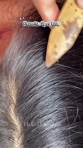 How to Remove Lice: Safe At-Home Lice Removal Guide
