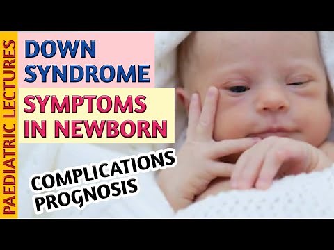 Down Syndrome Symptoms In Newborn Baby & Child
