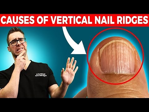 Vertical Ridges on Nails [What Are Your NAILS Trying to tell YOU!]
