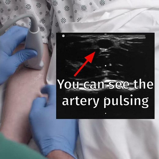 Ultrasound IV Insertion