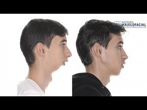 XAVI: Class II, mandibular hypoplasia - Bimaxillary advancement, mentoplasty, septoplasty