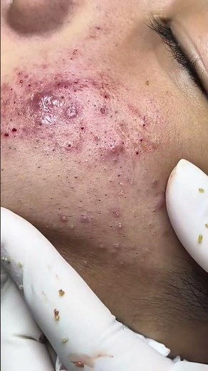 07Acne!!!#sebum #pimple #pimplepop #foypage #tiktok #cyst #cystremoval #comedon #acnetreatment