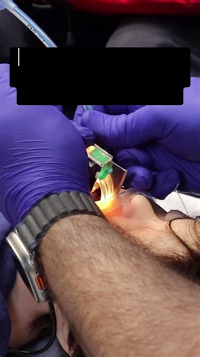 Master Your Medics on Instagram: "Kids aren’t just small adults, especially when it comes to airways. The wrong tube size can mean massive leaks… or airway trauma. So we keep the math simple, fast, and age-based. The Go-To Formula (Cuffed Tubes — now preferred) (Age ÷ 4) + 3.5 = Cuffed ETT size Example: 6-year-old → (6 ÷ 4) + 3.5 = 5.0 ETT How far should you insert? A quick rule: Tube size × 3 = depth at the lip Example: 5.0 ETT → 15 cm at teeth/lip (to start) Always confirm with capnography + c