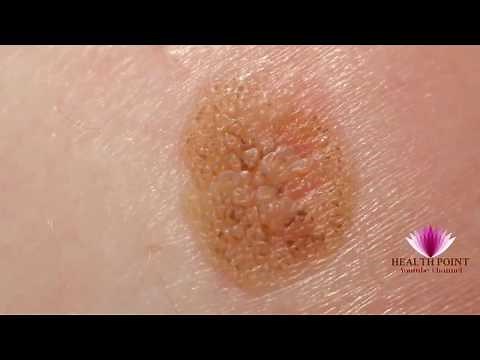 Melanoma Pictures - Signs, Symptoms, Causes, Photos, Images, Pictures of Melanoma Skin Cancer