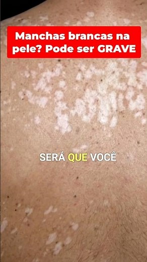 White spots on the skin? It could be THIS! #borchardtdermatologia #dermatologist #whitespots