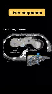 #liver #ctliver | CT Scan and MRI study