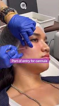 Cheek fillers using RHA 4 Teoxane