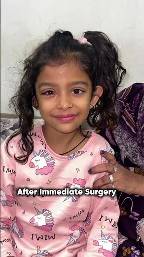 V-Pattern Exotropia Explained | Squint Surgery, Diagnosis & Treatment | Dr Ankit Shah