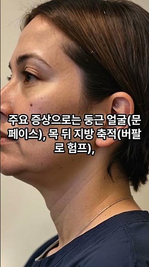 #쿠싱증후군이란?#쿠싱증후군#쿠싱#증후군#부신#코르티솔#비만#복부비만#질환#건강#당뇨