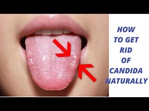 ☑️7 Tips How to get rid of Candida yeast infections Naturally. Cure with home remedies.🍏
