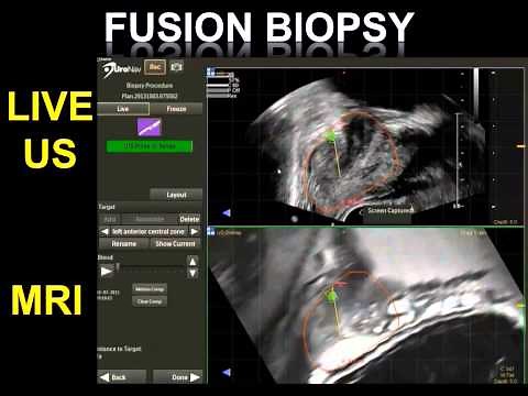 What is a MR US Fusion Guided Prostate Biopsy?