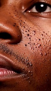 Unbelievable! Deep Cyst Pimple Explodes Instantly! | Pitbull terrier. | Facebook