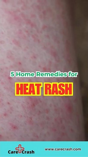 5 Instant Heat Rash Home Remedies | #carecrash