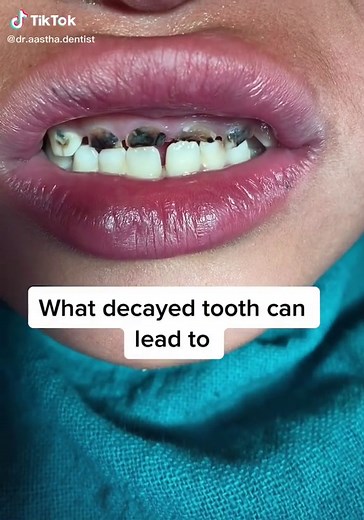 Importance of Caring for Milk Teeth in Children