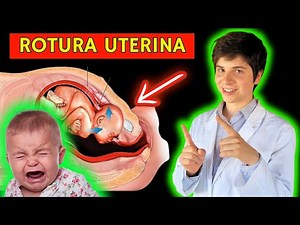 ✅ ROTURA UTERINA: PARA PRINCIPIANTES. SÍNTOMAS, FISIOPATOLOGÍA Y MANEJO