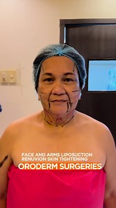 10K views · 44 reactions | YOUR LIPO CHOICES / Here are the options...