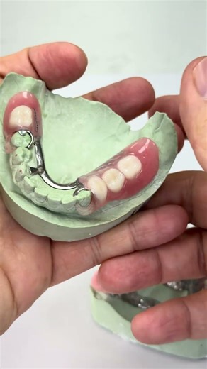 Clear clasps from Metal partial!