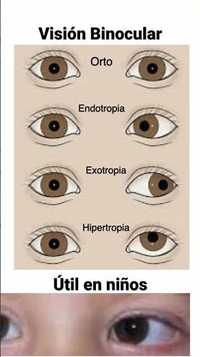 Test de Hirschberg. Visión Binocular. Estrabismo.