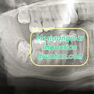 Mesioangular Third Molar Extraction
