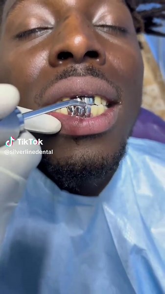 Understanding Permanent Silver Teeth for Kids