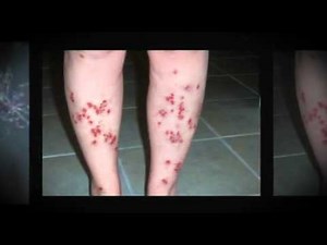 The DEBILITATING World Of Morgellons Disease - Learn How Help Is Available