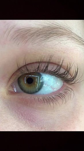 Lash Serum Use Leads to Unexpected Hair Growth