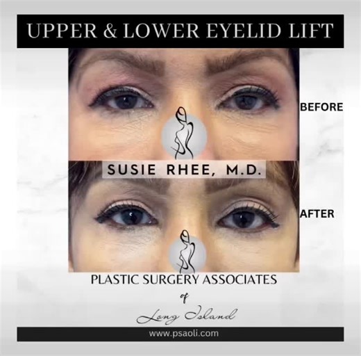 😍😍😍 Upper & Lower Eyelid Lift (Upper Blepharoplasty, Lower Blepharoplasty with Skin Pinch). This sweet patient of mine was dissatisfied with the appearance of her upper and lower eyelids which she felt made her look tired and aged. She opted to have an upper and lower blepharoplasty with board-certified plastic surgeon, Dr. Susie Rhee. Here are her before and afters! We are absolutely thrilled with how rejuvenated she looks. She looks like a rested and refreshed version of herself! ***Photos/