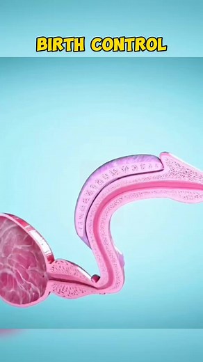 Birth Control 3D Animation #medical #doctor #3danimation #medicaldevice | T.Medical.V