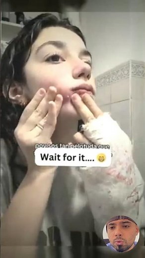 Popping huge blackheads and Giant Pimples- Best Pimple Popping Videos#blackheads #pimplepopping