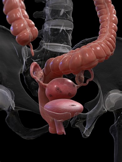 Understanding Endometriosis: A Systemic Disease