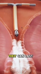5.4K views · 39 reactions | How IUDs Prevent Pregnancy (3D Animation) #iud #prevent #pragnancy #stop #hormone #lining #ovulation #implant #implants #fertilized #medical3danimation #3dmedicalanimation | Surgery Page | Facebook
