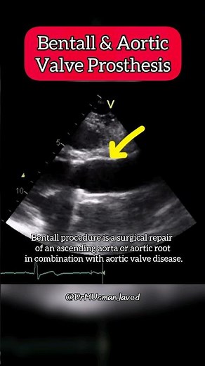 Bentall and aortic Valve Prosthesis on Echocardiography #aortic #Heart