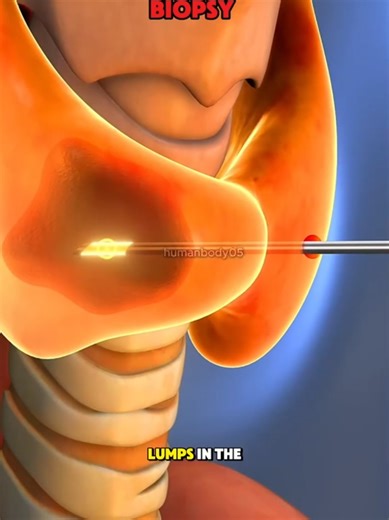 Thyroid Nodule Biopsy Explained (3D Animation)