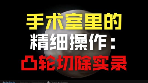 股骨髋臼撞击症：凸轮病灶骨成形术