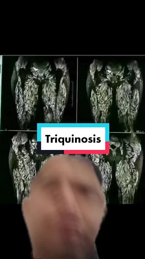 Todo sobre triquinosis y su tratamiento