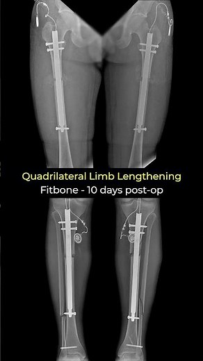 X-Ray - Quadrilateral Limb Lengthening with Fitbone