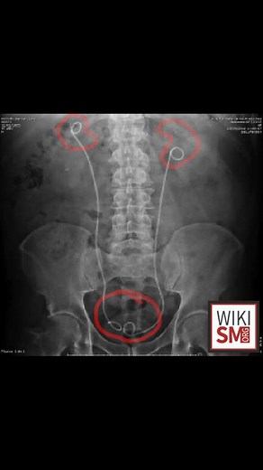 This is a KUB xray of a patient with kidney stones. Pictured are bilateral double J ureteral stents. These are placed to bypass blockage of kidney stones and allow normal drainage of urine into the bladder. There are no obvious kidney stones pictured. Read: https://mededcases.com/kidney-stones/ Watch: https://www.youtube.com/watch?v=Vxtg7EdsEjM #MedEd #MedicalEducation #Medicine #MedSchool #MedStudent #MedicalStudentLife #nurse #doctor #NurseLife #DoctorLife #paschool #medicalschool #palife #phy