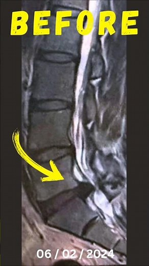 How Disc Extrusion Heal on Their Own #extrusion #discbulges #backpainrelief #backpain