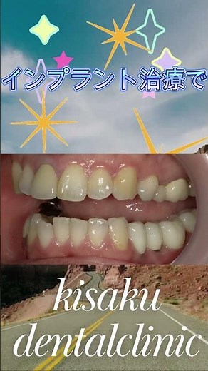 インプラント ビフォーアフター 疲れがたまると左下の歯茎が痛む 【Before & After】 #インプラント治療＃きさくデンタル＃歯医者
