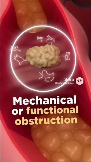Intestinal Obstruction – 3D Medical Visualization #shortvideo